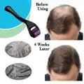Derma Roller For Hair Loss Treatment image 1