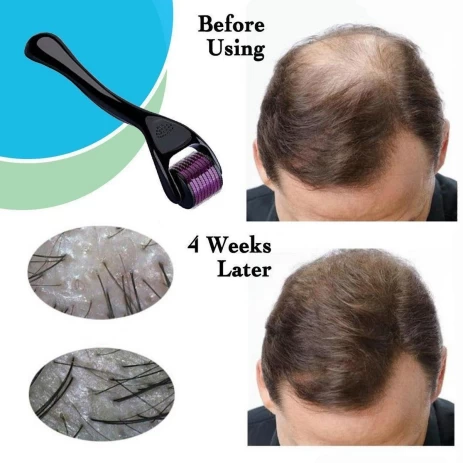 Derma Roller For Hair Loss Treatment